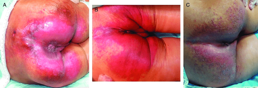 iad Incontinence Associated Dermatitis