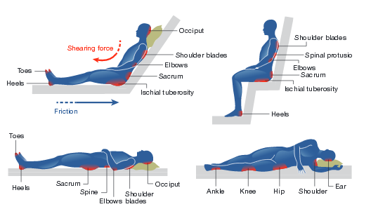 pressure-areas Pressure Areas