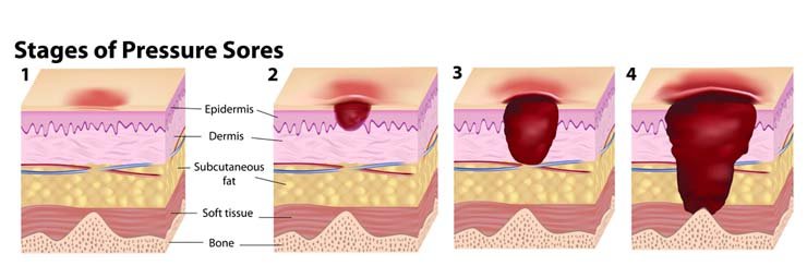 stages-of-pressure-ulcers Stages of Pressure Ulcers