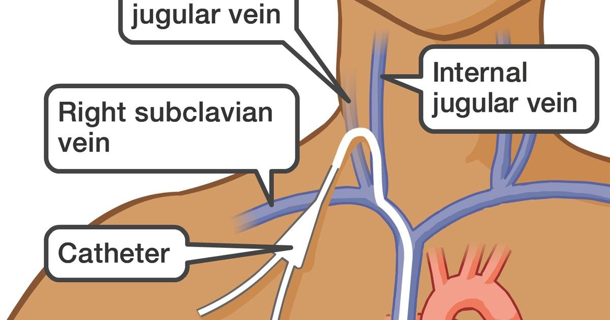 Central_venous_line_MED_ILL_EN (1)