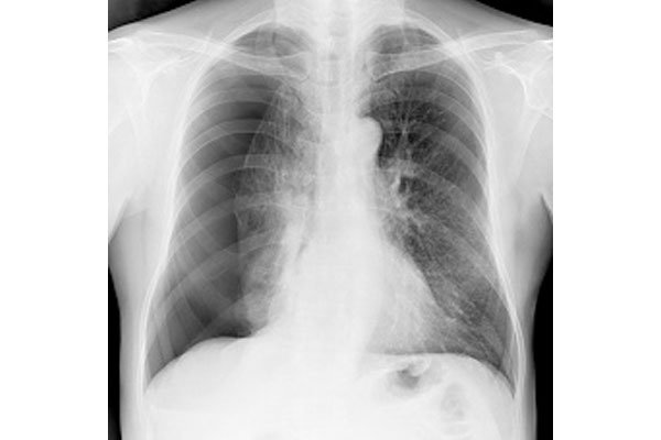 collapsed-lung-1