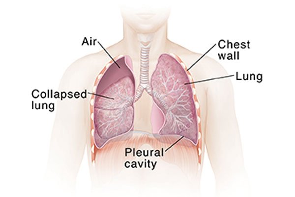 collapsed-lung-2