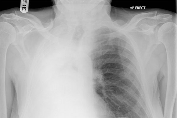 collapsed-lung-3
