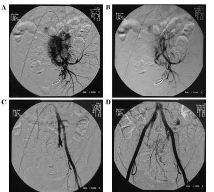 digital-subtraction-angiography-01