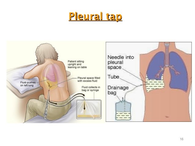 pleural-fluid-tapping-01