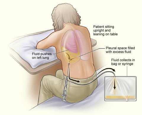 pleural-fluid-tapping-02