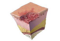 pressure-ulcer-stage-2