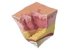 pressure-ulcer-stage-3