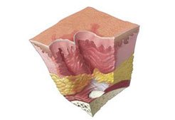 pressure-ulcer-stage-4