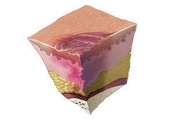 pressure-ulcer-stage-5