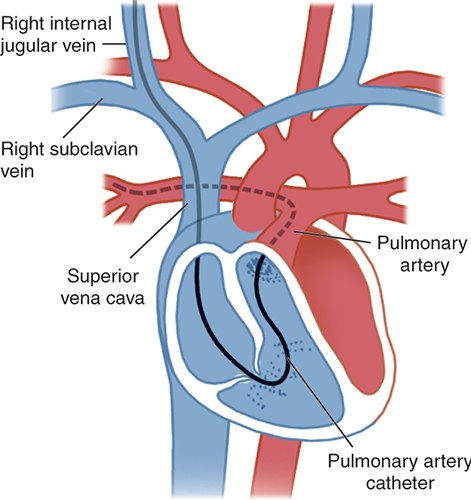 pulmonary-artery-catheter-insertion-1