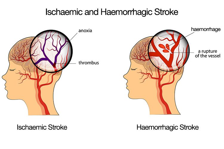 stroke-07