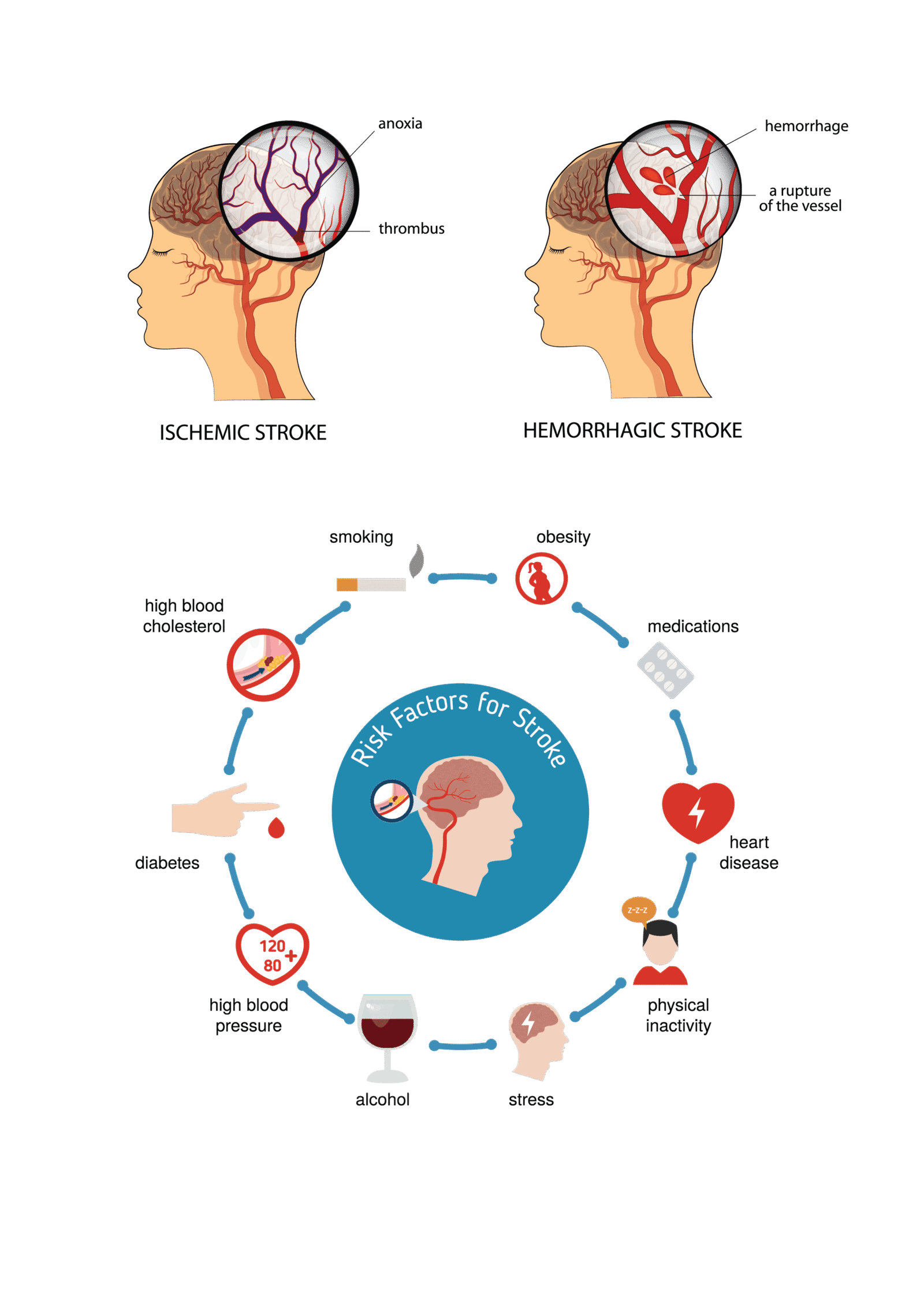 stroke_and_risk_factors-01
