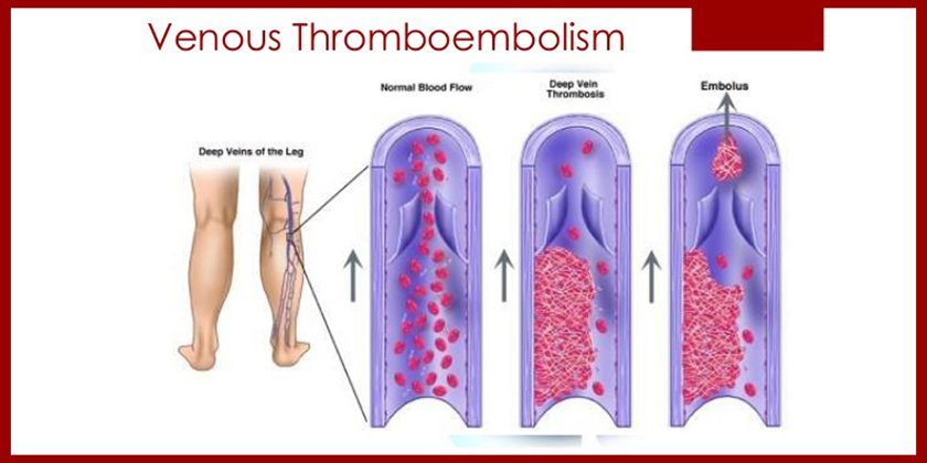 venous-thromboembolism-01