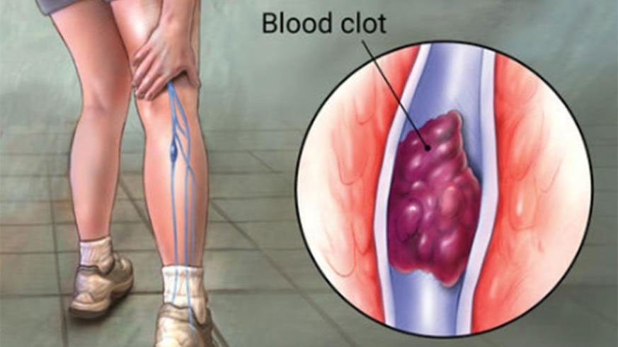 venous-thromboembolism-1