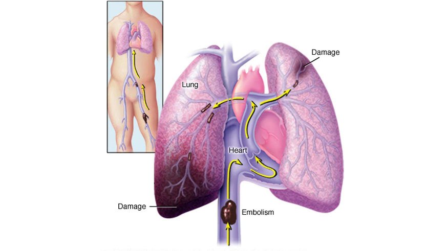 venous-thromboembolism-2