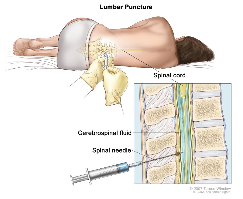 Lumbar Puncture Lumbar Puncture