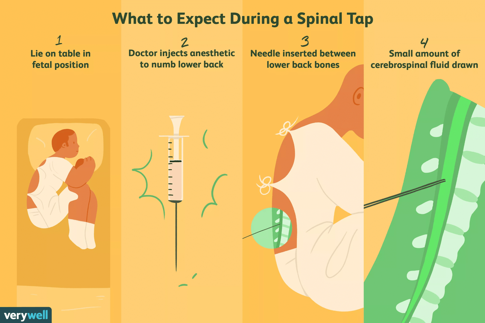 lumbar-puncture-02