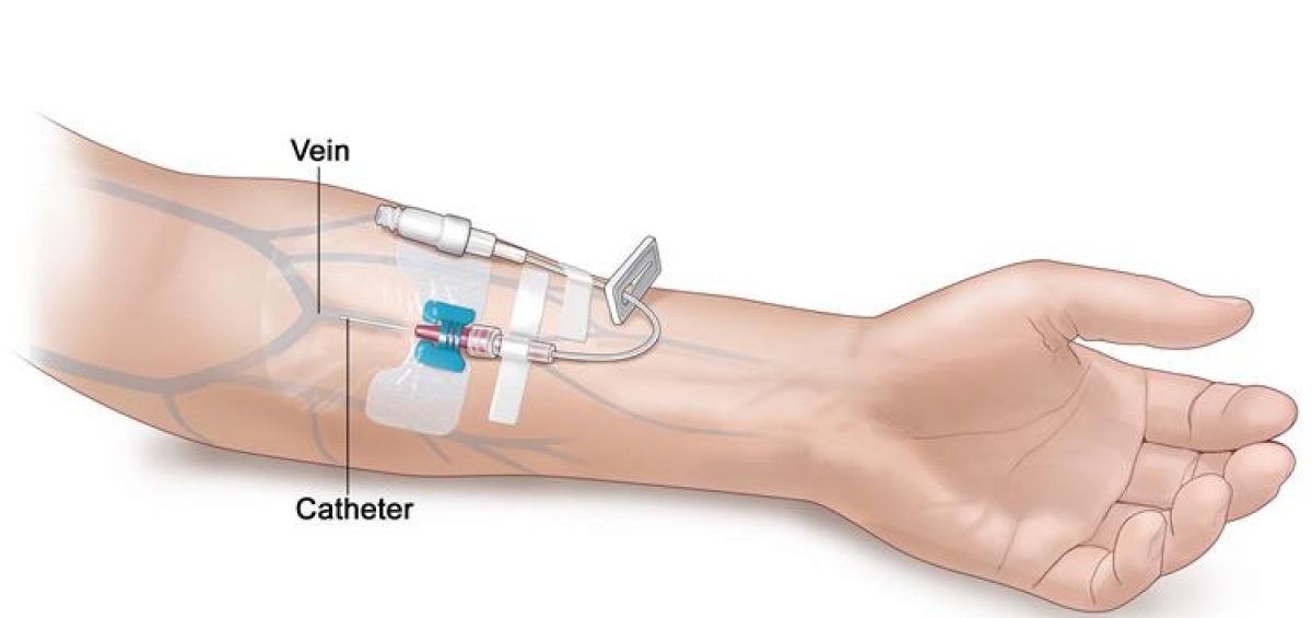 peripheral-catheter-insertion-01