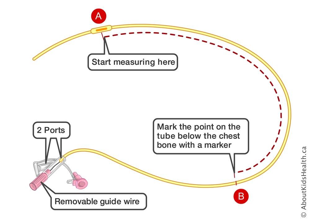 ryles-tube-insertion-01