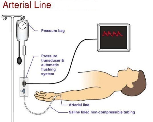 arterial-line-insertion-01