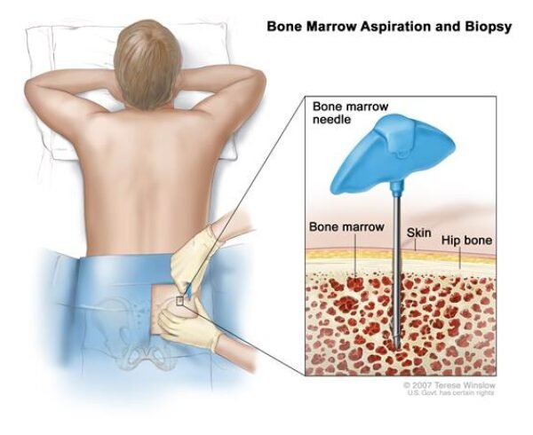 Bone Marrow Biopsy