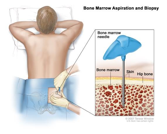 bone-marrow-biopsy-01 Bone Marrow Biopsy