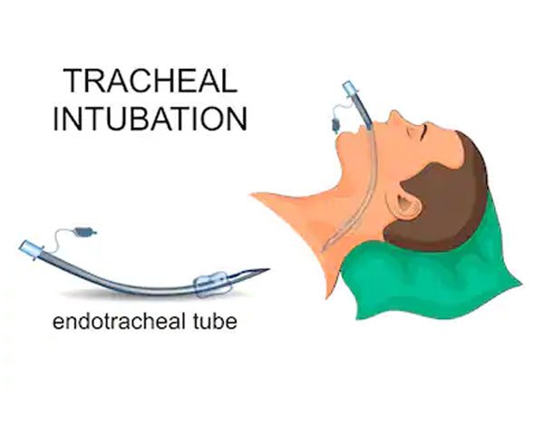 intubation-01