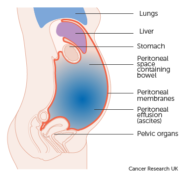 Diagram-showing-fluid-in-the-abdomen