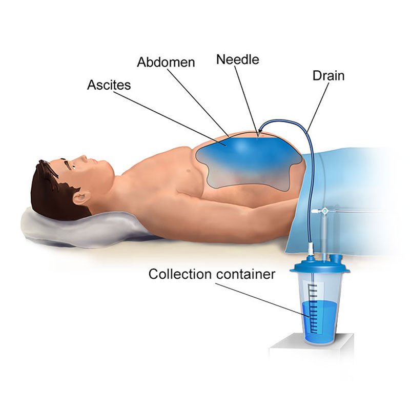 Paracentesis-1