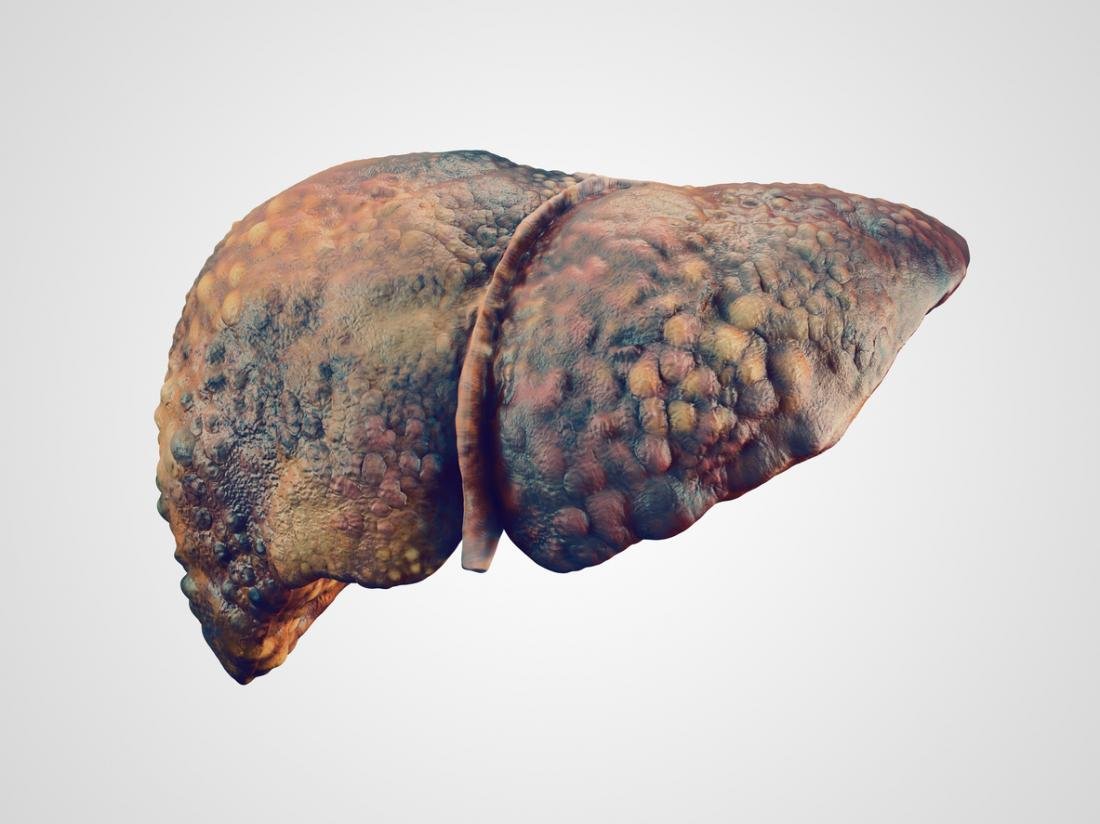 diseased-liver